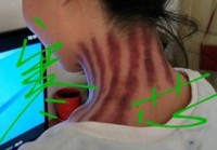 最新寒芯揪痧视频，现代解读下的中医传统疗法（2020寒芯揪痧视频）